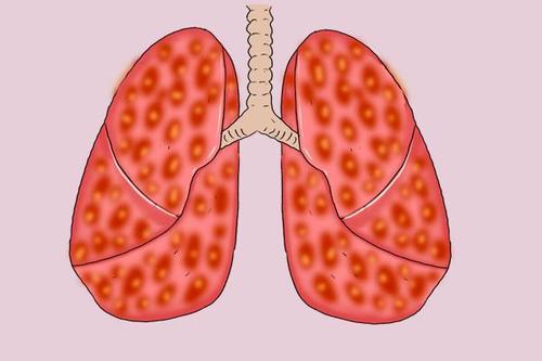 肺部肿瘤的症状有哪些?
